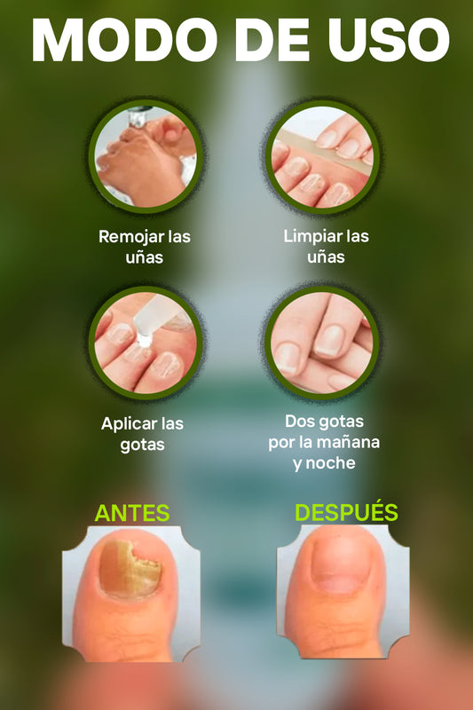 TERBINAFINA GOTAS ANTIMICOTICAS